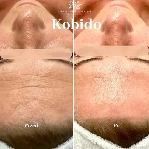 Jeden krok do świata piękna - zabieg peelingu chemicznego