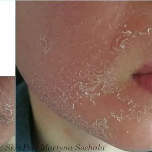 Trądzik, skóra z problemami? Wypróbuj peeling chemiczny!