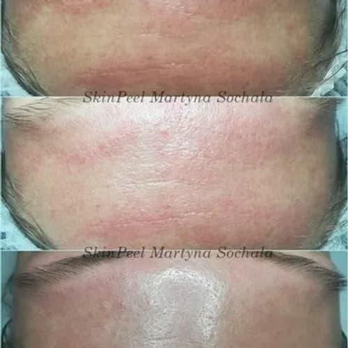 Trądzik, skóra z problemami? Wypróbuj peeling chemiczny!