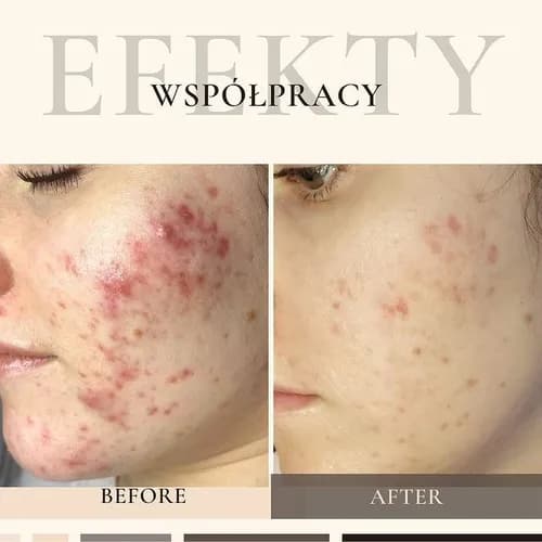 Химический пилинг - твой рецепт сияния