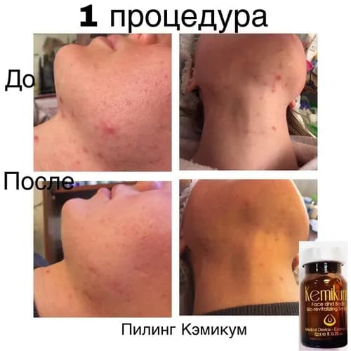 Odkryj swoje piękno dzięki peelingowi chemicznemu!