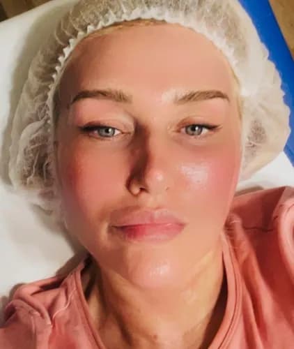 Chcesz, aby Twoja skóra nabrała blasku? Skorzystaj z usługi peelingu chemicznego.