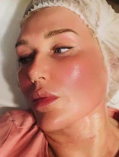 Chcesz, aby Twoja skóra nabrała blasku? Skorzystaj z usługi peelingu chemicznego.