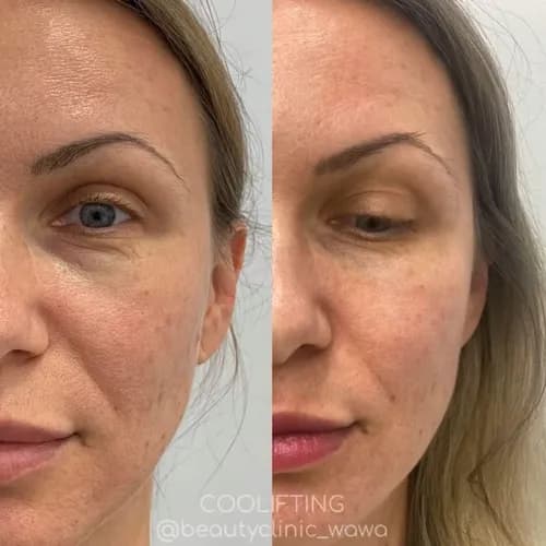 Peeling chemiczny — nowa skóra
