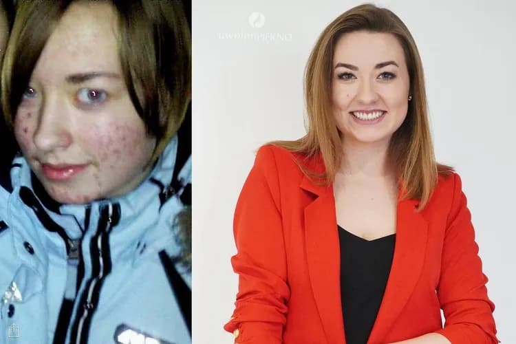 Акне? Химический пилинг - решение для проблемной кожи