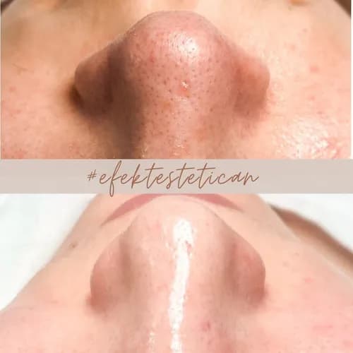 Peeling chemiczny - nowe życie dla Twojej skóry!