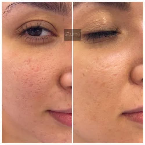 Chcesz mieć piękną, zdrową skórę? Zafunduj sobie peeling chemiczny!