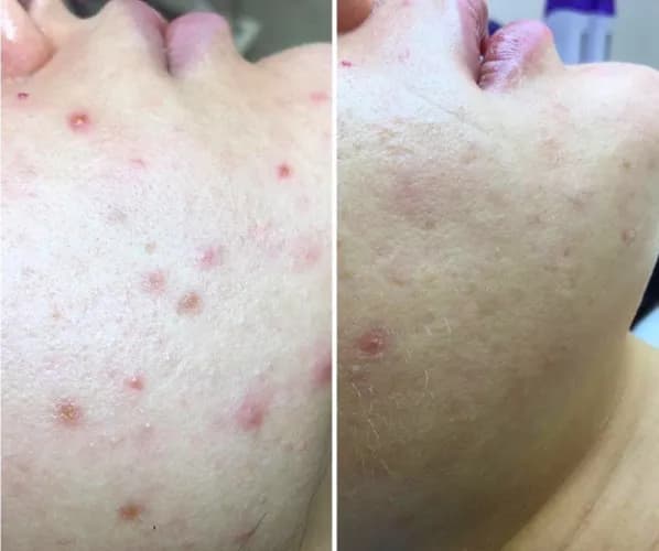 Замов послугу механічна чистка обличчя.