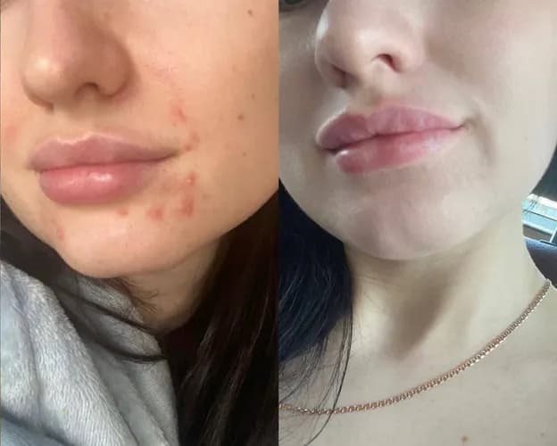 После механической чистки лица твое лицо обретет сияние