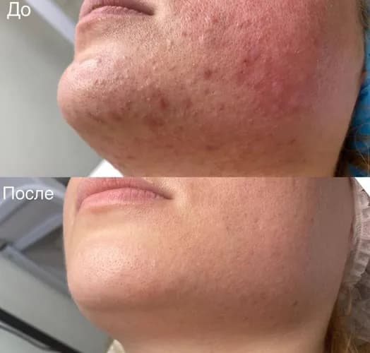 После механической чистки лица твое лицо обретет сияние