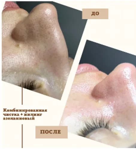 Twoja skóra będzie aksamitnie miękka po kompleksowym oczyszczaniu twarzy!