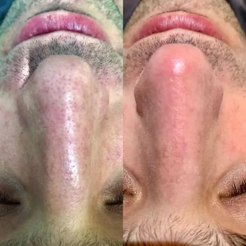 Комбінована чистка обличчя - запорука здорової шкіри.