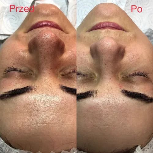 Комбінована чистка обличчя - запорука здорової шкіри.