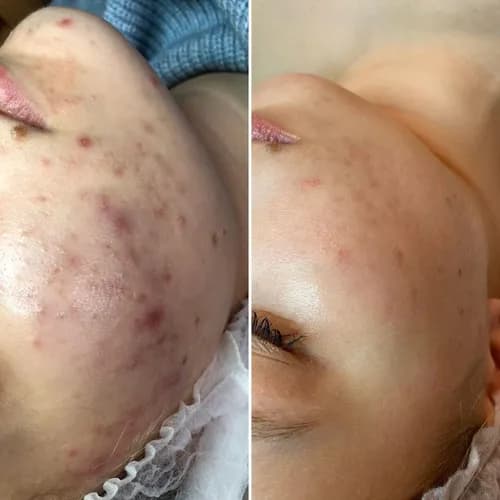 Oczyszczanie twarzy: skuteczna kombinacja metod