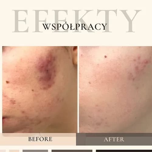 Ultradźwiękowe i ręczne oczyszczanie twarzy