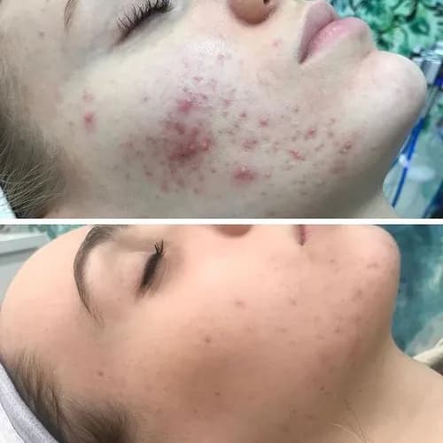 Oczyszczanie twarzy ultradźwiękami i ręcznie: efektowna metoda