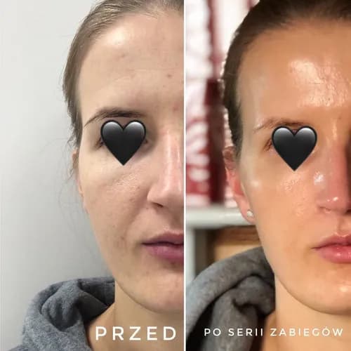 Peeling gazowo-ciekły: zdrowa i promienna skóra twarzy