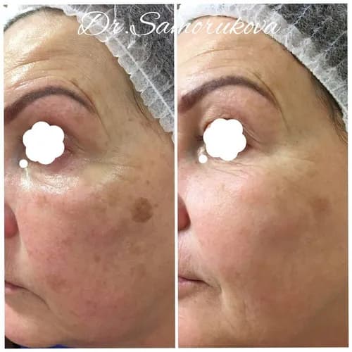 Peeling gazowo-ciekły twarzy: delikatne złuszczanie skóry