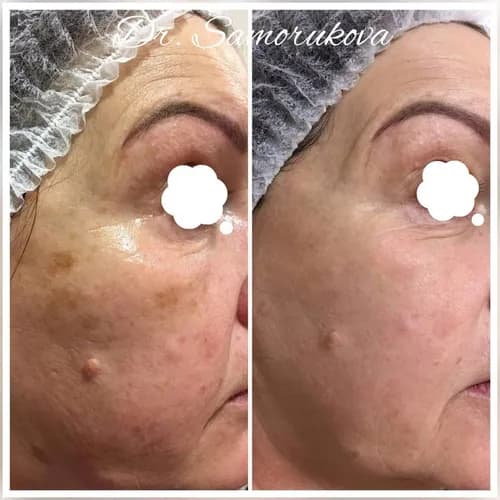 Peeling gazowo-ciekły twarzy: delikatne złuszczanie skóry