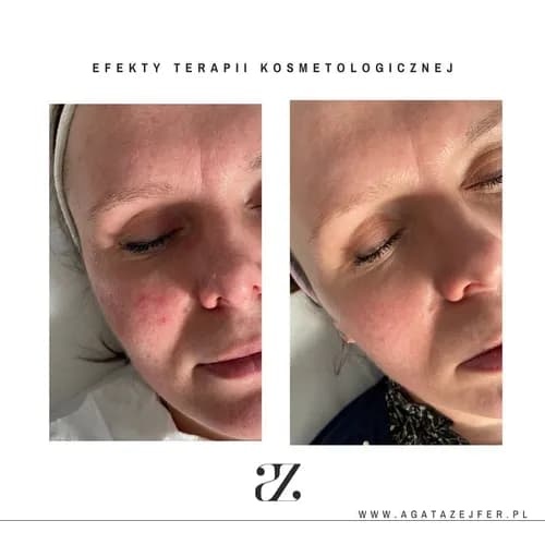 Газожидкостный пилинг: эффективный способ омоложения кожи