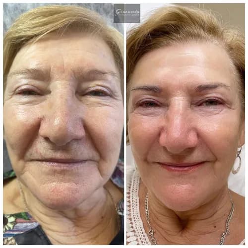 Эффективный газожидкостный пилинг лица: здоровая кожа скоро