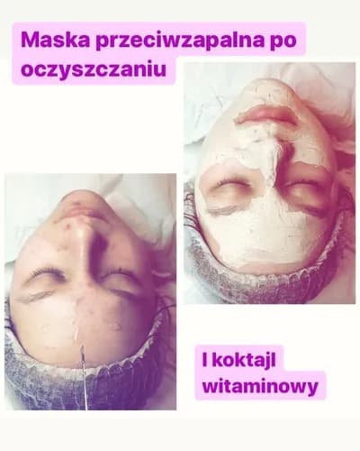Чистка лица без боли: атравматический метод ухода
