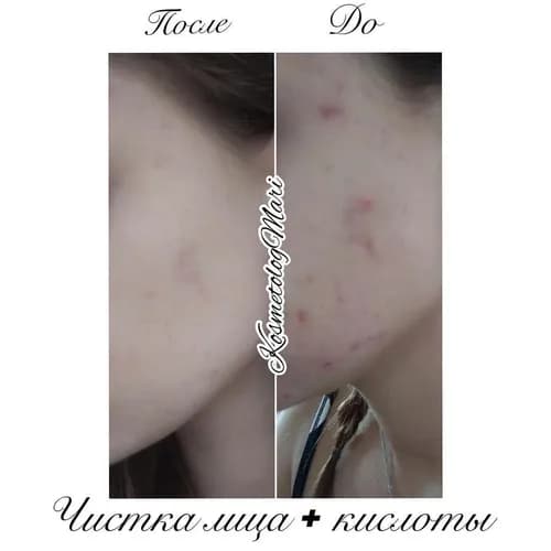 Twarz bez zanieczyszczeń: atraumatyczne oczyszczanie skóry