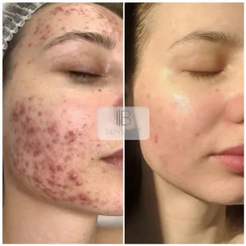 Ultradźwiękowy peeling twarzy