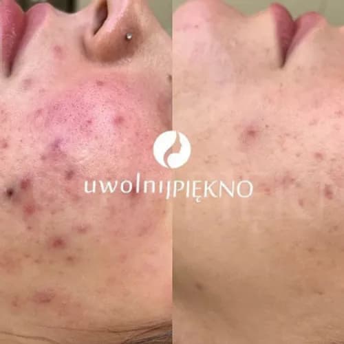Oczyszczanie twarzy peelingiem ultradźwiękowym