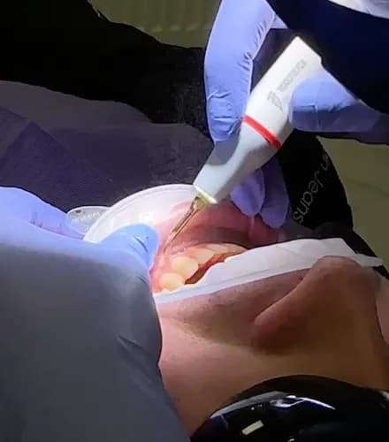 Usuwanie kamienia i osadu: Zdrowe dziąsła i świeży oddech