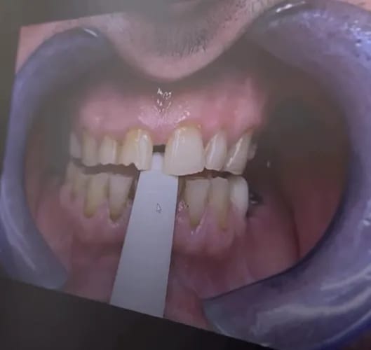 Leczenie próchnicy w Warszawie — bez bólu i z zachowaniem zęba