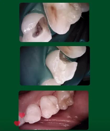 Bezbolesne leczenie próchnicy w Warszawie — spokojnie i bez stresu