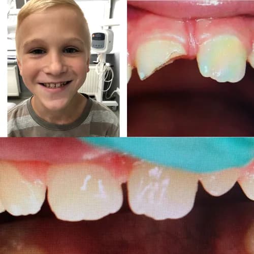 Художественная реставрация и восстановление зубов без коронок | Варшава