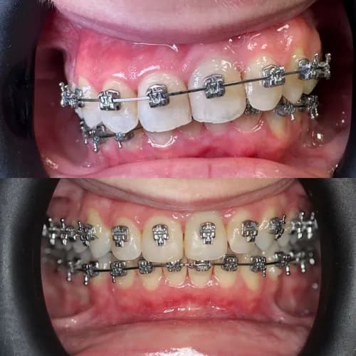 Потрібні брекети? Встановлення брекет-систем у Варшаві