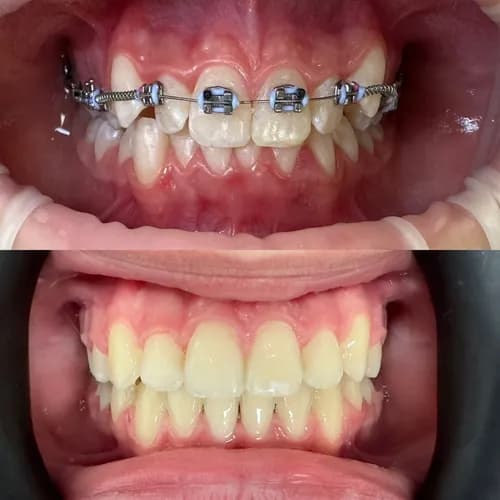 Потрібні брекети? Встановлення брекет-систем у Варшаві