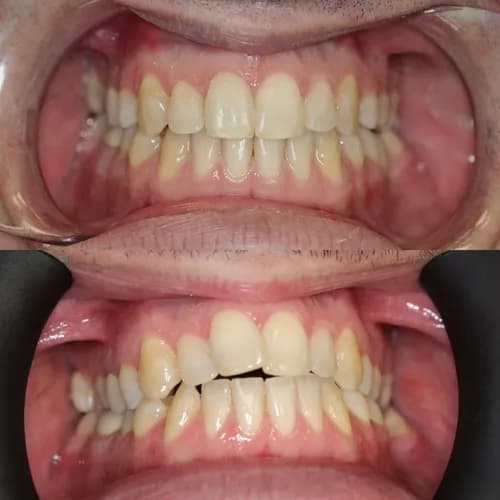 Потрібні брекети? Встановлення брекет-систем у Варшаві