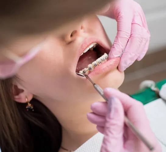 Потрібні брекети? Встановлення брекет-систем у Варшаві