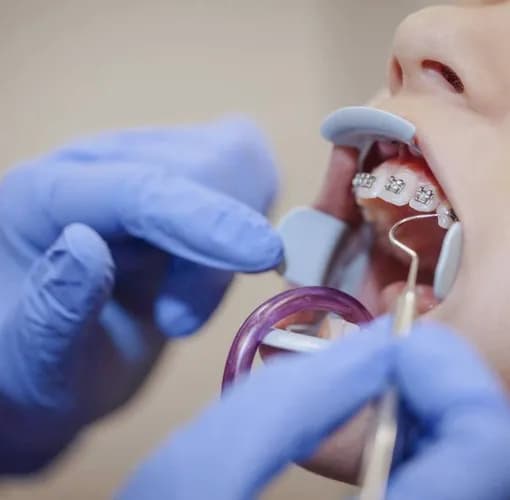 Потрібні брекети? Встановлення брекет-систем у Варшаві