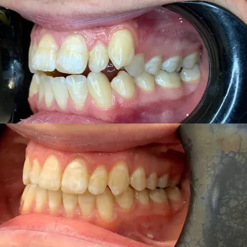 Потрібні брекети? Встановлення брекет-систем у Варшаві