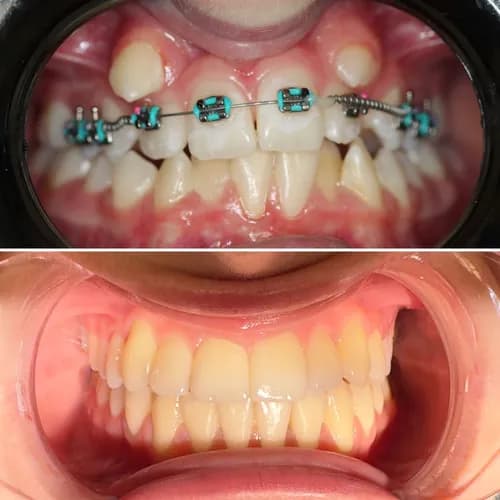 Потрібні брекети? Встановлення брекет-систем у Варшаві