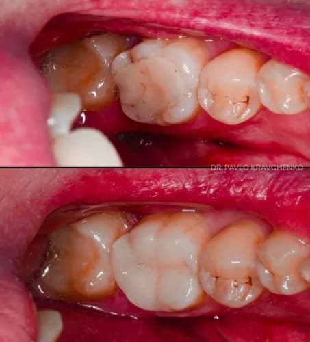 Стара пломба сидить роками? Під нею щось гниє - заміна пломби у Варшаві