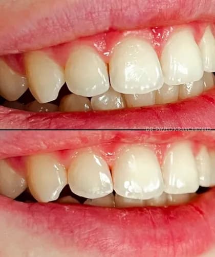 Пора на полірування та чистку у Варшаві. Відчуваєш шорсткі зуби язиком?