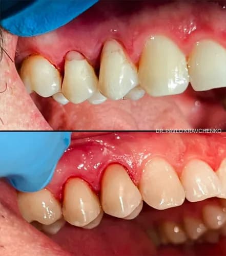 Пора на полірування та чистку у Варшаві. Відчуваєш шорсткі зуби язиком?