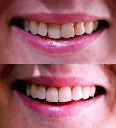 Зробимо красиві й натуральні зуби — реставрація у Варшаві