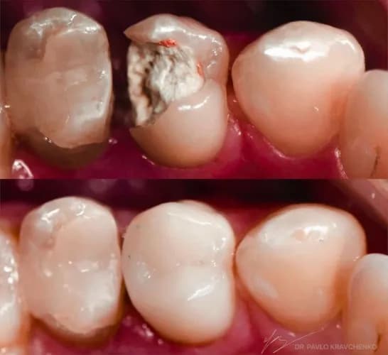 Терміново лікування карієсу поки не пізно Варшава