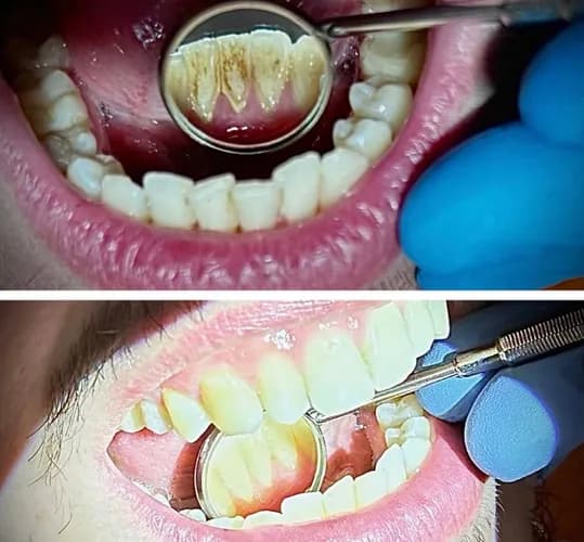 Професійна гігієна зубів у Варшаві