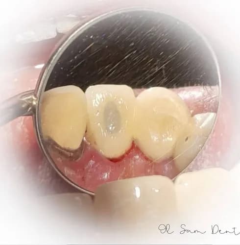 Зуб лікували, а він знову болить? Перелікування каналів Варшава