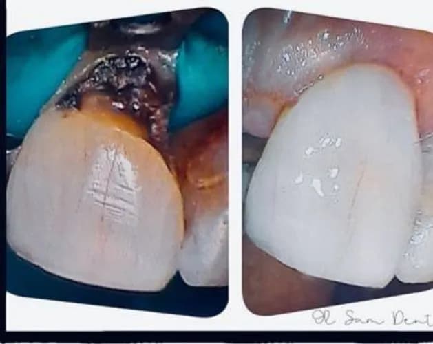 Зуб зламався, але не вирвали - поставили коронку Варшава