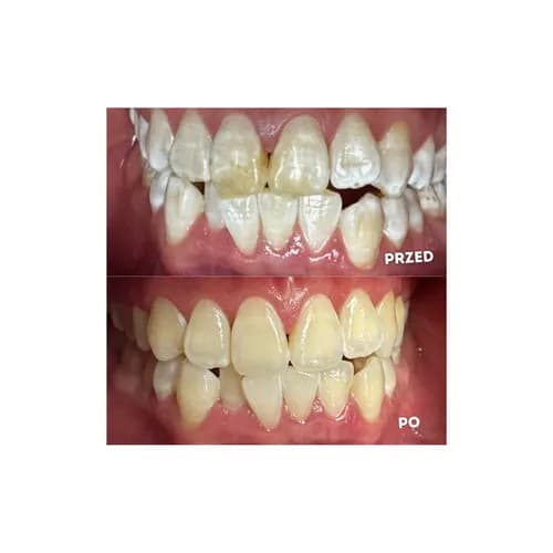Przebarwione zęby profesjonalne wybielanie stomatologiczne Warszawa