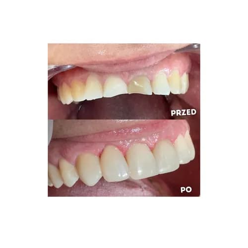 Przebarwione lub nierówne zęby licówki stomatologiczne Warszawa